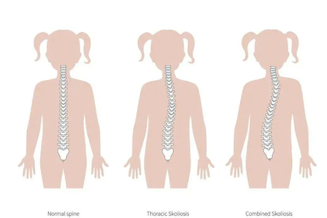如何自測(cè)孩子是否脊柱側(cè)彎