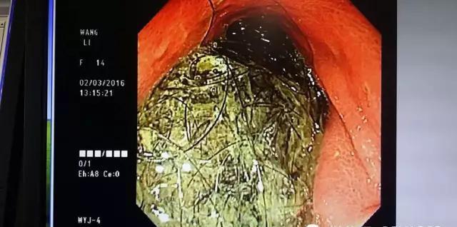 9歲女孩胃里取出直徑4厘米頭發(fā)團